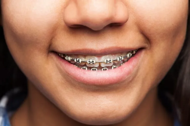 Orthodontics (Braces)